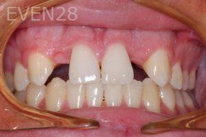 Nicholas-Shubin-Dental-Implants-before-3