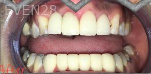 Nimesh-Patel-All-on-Four-Dental-Implants-after-2b