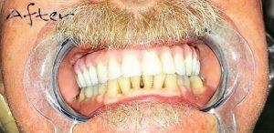 Nimesh-Patel-All-on-Four-Dental-Implants-after-2