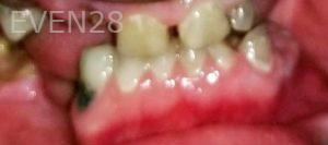 Nimesh-Patel-All-on-Four-Dental-Implants-before-1