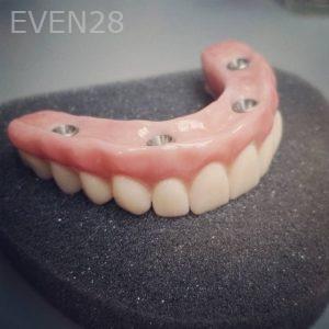 Nimesh-Patel-All-on-Four-Dental-Implants-before-1b