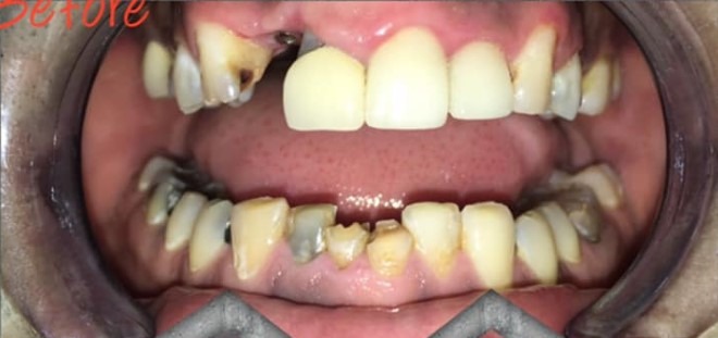 Nimesh-Patel-All-on-Four-Dental-Implants-before-2b