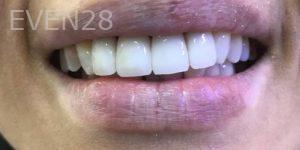 Nimesh-Patel-Dental-Crowns-after-1