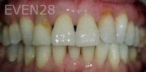 Nimesh-Patel-Dental-Crowns-before-1
