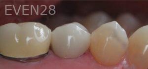 Nina-Basti-Dental-Crown-after-1b
