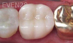 Nina-Basti-Dental-Crown-after-2