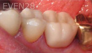 Nina-Basti-Dental-Crown-after-3