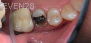 Nina-Basti-Dental-Crown-before-1