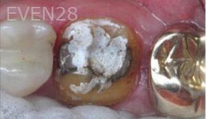 Nina-Basti-Dental-Crown-before-2