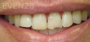 Patrick-Yoshikane-Dental-Bonding-Before-1