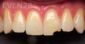 Patrick-Yoshikane-Dental-Bonding-Before-2