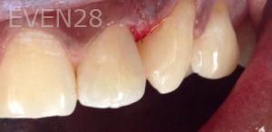 Pouria-Maleki-Dental-Bonding-after-5