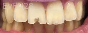 Pouria-Maleki-Dental-Bonding-before-3