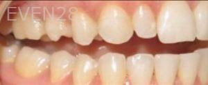 Pouria-Maleki-Dental-Bonding-before-4