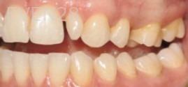 Pouria-Maleki-Dental-Bonding-before-4b