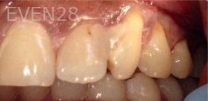 Pouria-Maleki-Dental-Bonding-before-5