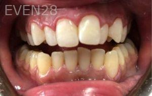 Pouria-Maleki-Dental-Crowns-after-1b