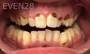 Pouria-Maleki-Dental-Crowns-before-1