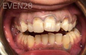 Pouria-Maleki-Dental-Crowns-before-1b