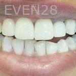 Ramin-Khoshsar-Dental-Crowns-After-1