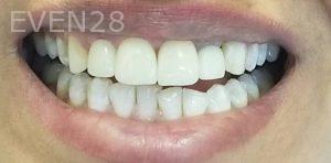 Ramin-Khoshsar-Dental-Crowns-After-1