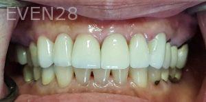 Ramin-Khoshsar-Dental-Crowns-After-2