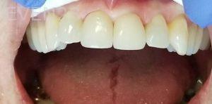 Ramin-Khoshsar-Dental-Crowns-After-3