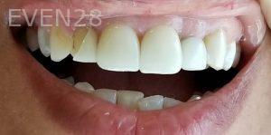 Ramin-Khoshsar-Dental-Crowns-Before-1