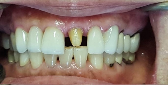 Ramin-Khoshsar-Dental-Crowns-Before-2