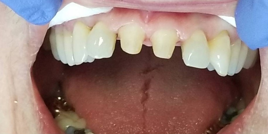 Ramin-Khoshsar-Dental-Crowns-Before-3