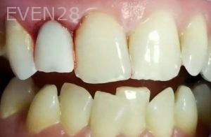 Ramin-Khoshsar-Dental-Implant-After-1a