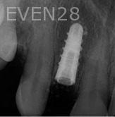 Ramin-Khoshsar-Dental-Implant-After-1b