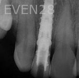 Ramin-Khoshsar-Dental-Implant-After-1c