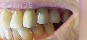 Ramin-Khoshsar-Dental-Implant-After-2