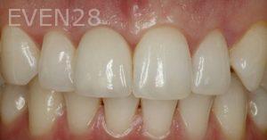 Ramin-Khoshsar-Dental-Implant-After-3