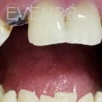 Ramin-Khoshsar-Dental-Implant-Before-1a