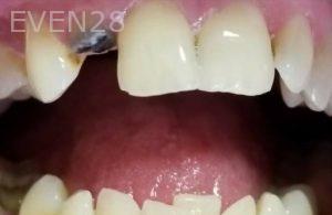 Ramin-Khoshsar-Dental-Implant-Before-1a