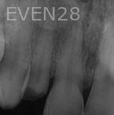 Ramin-Khoshsar-Dental-Implant-Before-1b