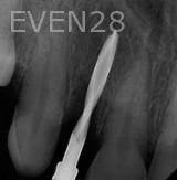 Ramin-Khoshsar-Dental-Implant-Before-1c