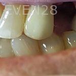 Ramin-Khoshsar-Dental-Implant-Before-2