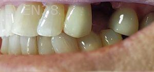 Ramin-Khoshsar-Dental-Implant-Before-2