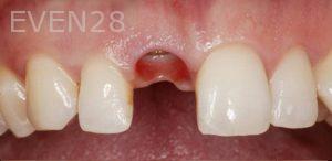 Ramin-Khoshsar-Dental-Implant-Before-3