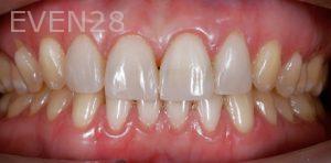 Ramin-Khoshsar-Porcelain-Veneers-After-1