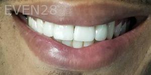 Ramin-Khoshsar-Porcelain-Veneers-After-2