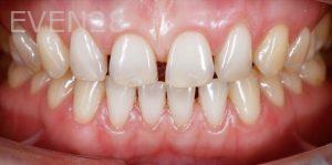 Ramin-Khoshsar-Porcelain-Veneers-Before-1