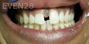 Ramin-Khoshsar-Porcelain-Veneers-Before-2