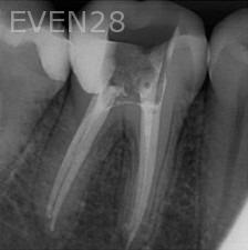 Ramin-Khoshsar-Root-Canal-Therapy-After-1