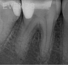 Ramin-Khoshsar-Root-Canal-Therapy-Before-1a