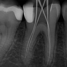 Ramin-Khoshsar-Root-Canal-Therapy-Before-1b