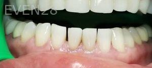 Ramin-Khoshsar-Teeth-Whitening-After-1